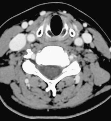 FIGURE 36-2, Axial computed tomography image demonstrating left C5-C6 foraminal spondylotic stenosis.