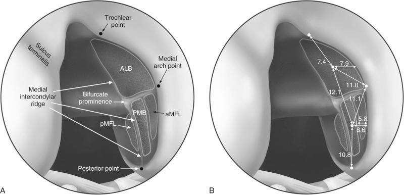 FIG 16-11, A, The arthroscopic view of the femoral attachment of the posterior cruciate ligament (PCL) in a right knee, demonstrating pertinent landmarks. B, Illustration showing the quantitative measurements for the femoral attachment of the PCL. The values are reported in millimeters. ALB , Anterolateral bundle; aMFL , anterior meniscofemoral ligament; PMB , posteromedial bundle; pMFL , posterior meniscofemoral ligament.