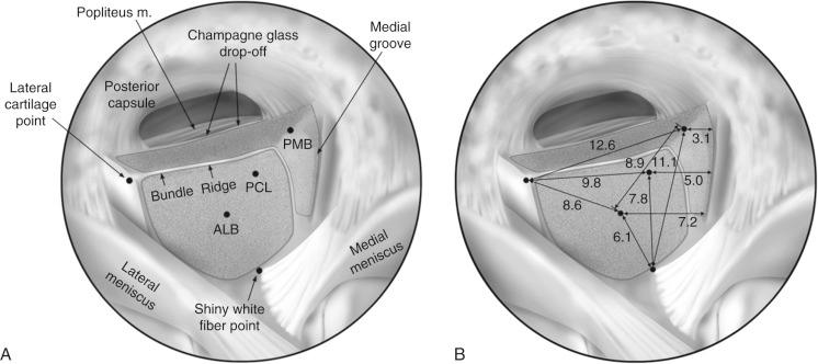 FIG 16-12, A, The arthroscopic view of the tibial attachment of the posterior cruciate ligament (PCL) in a right knee, demonstrating pertinent landmarks. B, Illustration showing the quantitative measurements for the tibial attachment of the PCL. The values are reported in millimeters. ALB , Anterolateral bundle; PMB , posteromedial bundle; m , muscle.