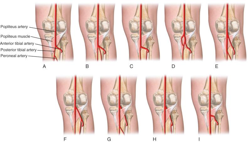 FIG 16-13, Anatomic variations of the popliteal artery and its branches. Diagrams represent posterior views of popliteal fossa and popliteus muscle. A, Normal. B, Trifurcating popliteal artery. C, Peroneal artery arising from low anterior tibial artery. D, “Island” popliteal artery (very rare). E, High anterior tibial origin passing superficial to popliteus muscle. F, Same as E with peroneal artery arising from anterior tibial artery. G, Same as E with anterior tibial artery passing deep to popliteus muscle. H, Same as F except anterior tibial artery passes deep to popliteus muscle. I, Absent posterior tibial artery. Note that the anterior tibial artery is at risk in the initial dissection proximal to the popliteus muscle in D through H .