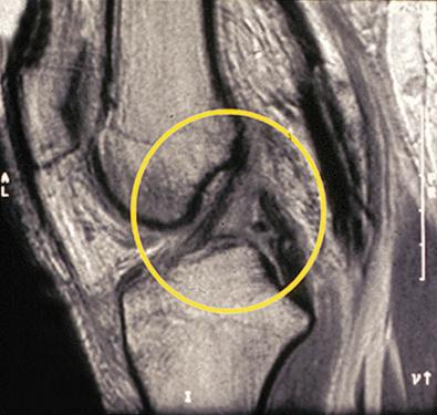 FIG 16-14, A partial posterior cruciate ligament (PCL) rupture is shown. Even though the magnetic resonance imaging suggests a complete rupture, there were remaining PCL fibers resisting posterior tibial subluxation.