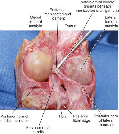 FIG 16-2, Posterior cruciate ligament femoral and tibial attachments. Note the prominent posterior meniscofemoral ligament and broad posterior tibial attachment.