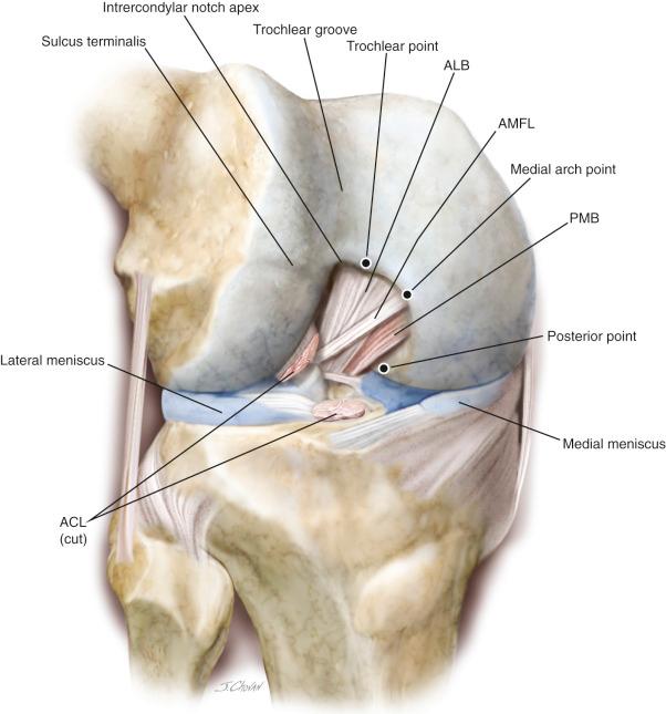 FIG 16-3, Anterior view of a right knee flexed to 90 degrees with the posterior cruciate ligament intact, demonstrating the characteristic morphology of the cartilage margin of the femoral intercondylar notch. The illustration also shows the trochlear, medial arch, and posterior points as well as the intercondylar notch apex and trochlear groove. ACL , Anterior cruciate ligament; ALB , anterolateral bundle; aMFL , anterior meniscofemoral ligament; PMB , posteromedial bundle.