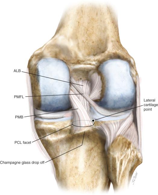 FIG 16-4, Illustration of the posterior aspect of a right knee with the posterior cruciate ligament (PCL) intact, demonstrating the fiber orientation. ALB , Anterolateral bundle; PMB , posteromedial bundle; PMFL , posterior meniscofemoral ligament.