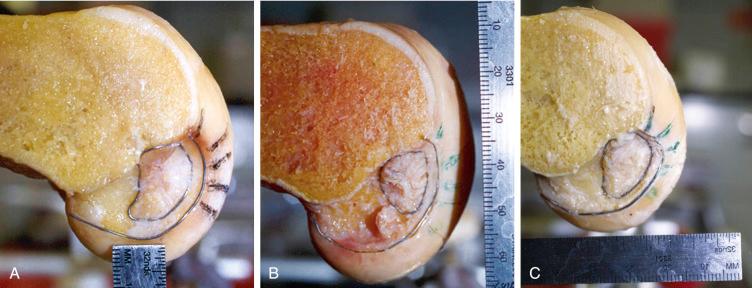 FIG 16-6, Composite of the shapes of different posterior cruciate ligament (PCL) insertion sites as seen on lateral views. Variability is noted among specimens from an oval to an elliptical PCL footprint configuration. Note the differences in anterior-to-posterior and proximal-to-distal dimensions in the PCL footprint. The most common shape of the PCL footprint is elliptical. A, Note that the fibers insert proximally to the intercondylar roof. The PCL footprint is smaller in its anteroposterior dimension. B, Note the prominent posterior meniscofemoral ligaments. C, A more oval PCL attachment with greater proximal-to-distal width.