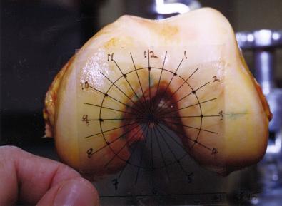 FIG 16-7, Clock-face markings on the medial femoral condyle as projected from a transparent sheet of acetate onto the notch viewed axially from a knee at 90 degrees of flexion.