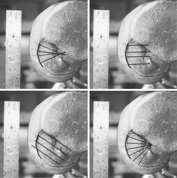 FIG 16-8, A, Measurement lines referenced from clock-face positions perpendicular to the cartilage edge. These reference lines represent the shortest distance to the distal margin of the posterior cruciate ligament (PCL) attachment. B, Measurement lines referenced from a clock-face position parallel to the femoral shaft. C, Measurement lines referenced from a clock-face position parallel to the intercondylar roof (5-mm increments). D, Measurement lines referenced radially from the intercondylar roof. These lines are directed from a center located at the most proximal extent of the PCL attachment onto the roof of the intercondylar notch. This point is, on average, located at approximately 60% of the roof depth. The line progresses from the 12 o'clock position ( top line ) to the 6 o'clock position ( bottom line ).