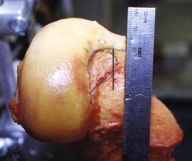 FIG 16-9, Reference line at the 12 o'clock position. The curved posterior cruciate ligament attachment is shown extending to the intercondylar roof.