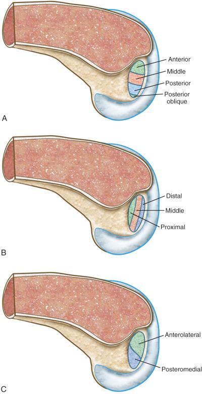 FIG 16-10, A, Rule of thirds: The posterior cruciate ligament (PCL) footprint is divided into anterior, middle, and posterior thirds. The anterior third extends past the midline (12:30, left knee) and the posterior region extends to 5 o'clock. The smaller posterior oblique portion of the PCL footprint is also represented. The PCL footprint is elliptical in most knees, but variations exist. B, Rule of thirds: The PCL footprint is further divided into the distal, middle, and proximal thirds. This allows for more exact referencing of graft strand placement during PCL reconstruction. The PCL fibers in the distal two-thirds lengthen with knee flexion while the proximal fibers shorten. The reverse occurs with knee extension. C, Classical division of anterolateral and posteromedial bundles provides a general description of PCL fiber length change of anterolateral fibers that lengthen and posteromedial fibers that shorten with knee flexion.