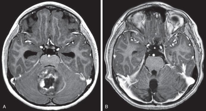 Figure 11.1, MRI of a pre- and postoperative pilocytic astrocytoma. (A) Axial T1-weighted and gadolinium-enhanced imaging demonstrating a midline, heterogeneously enhancing posterior fossa mass, which compresses the fourth ventricle anteriorly. Hydrocephalus is apparent from the dilatation of the temporal horns of the lateral ventricles. (B) Postoperative imaging confirming gross total resection of the tumor and resolution of hydrocephalus.