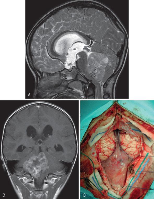 Figure 11.3, MRI of ependymoma. (A–B) Midsagittal and coronal contrast-enhanced images showing a midfloor type ependymoma extending from the floor of the fourth ventricle. (C) Operative view of the tumor following a suboccipital midline craniotomy.