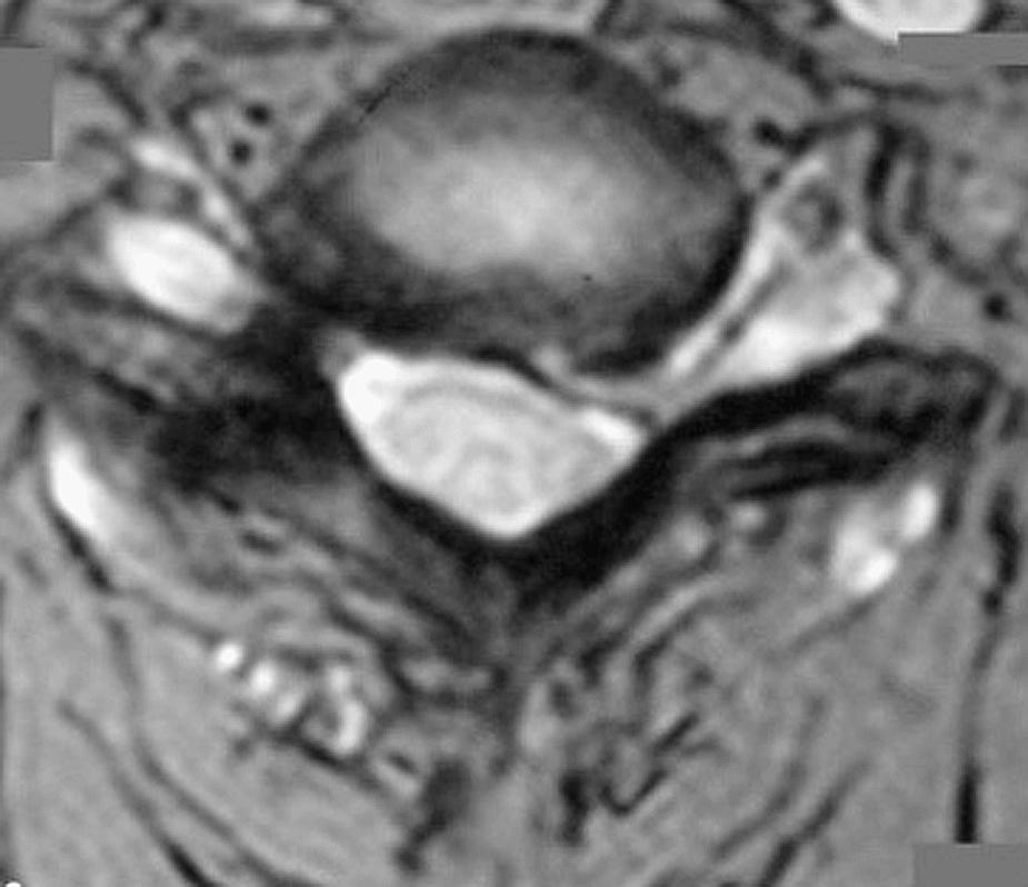 Fig. 108.1, Axial T2-weighted cervical spine magnetic resonance imaging demonstrates a laterally herniated disc to the left with resultant effacement of the lateral thecal sac and compression of the exiting nerve root.
