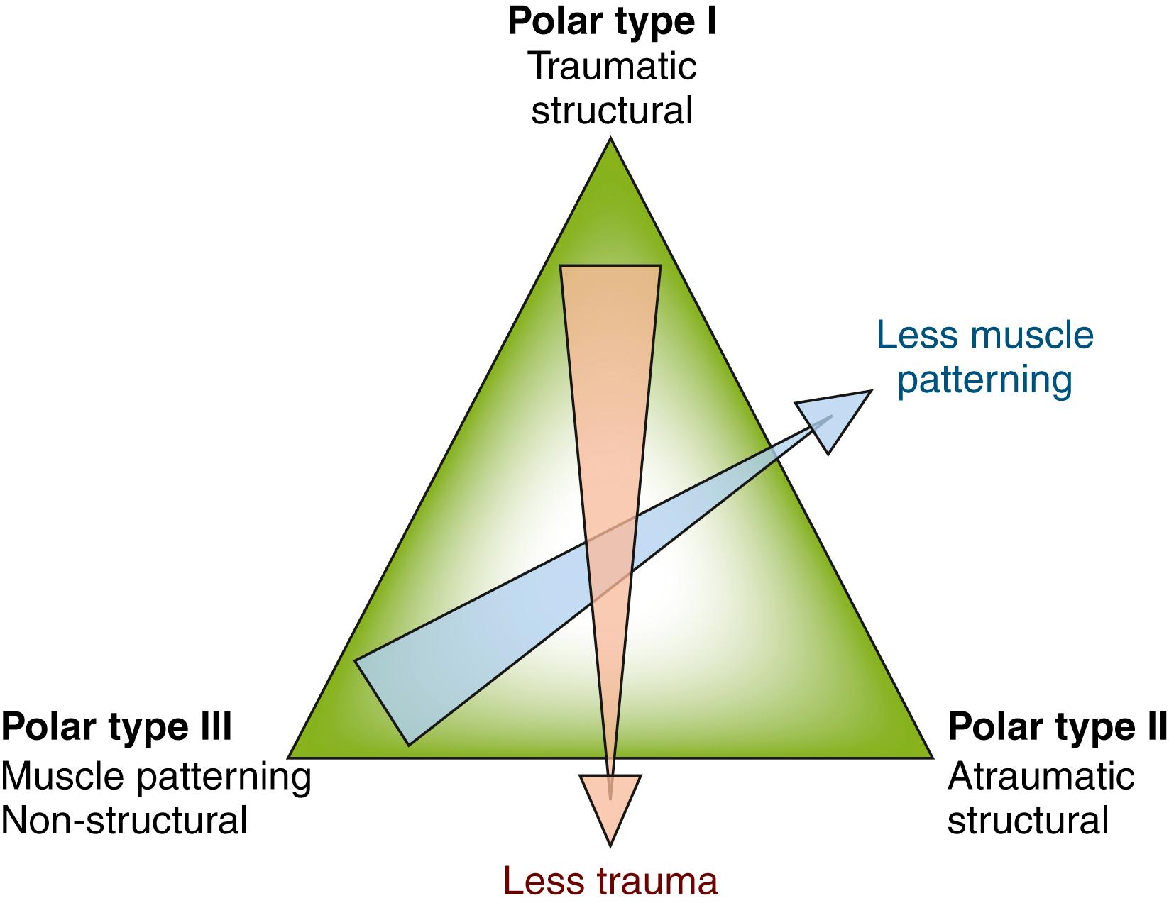 Fig. 23.2, Stanmore’s triangle for shoulder instability is a graphic representation of the interplay between traumatic, ligamentous, and muscle firing aspects of shoulder instability. Individuals may fall mostly on one point (e.g., forceful traumatic mechanism) or be a blend of several factors, each of which bears consideration.