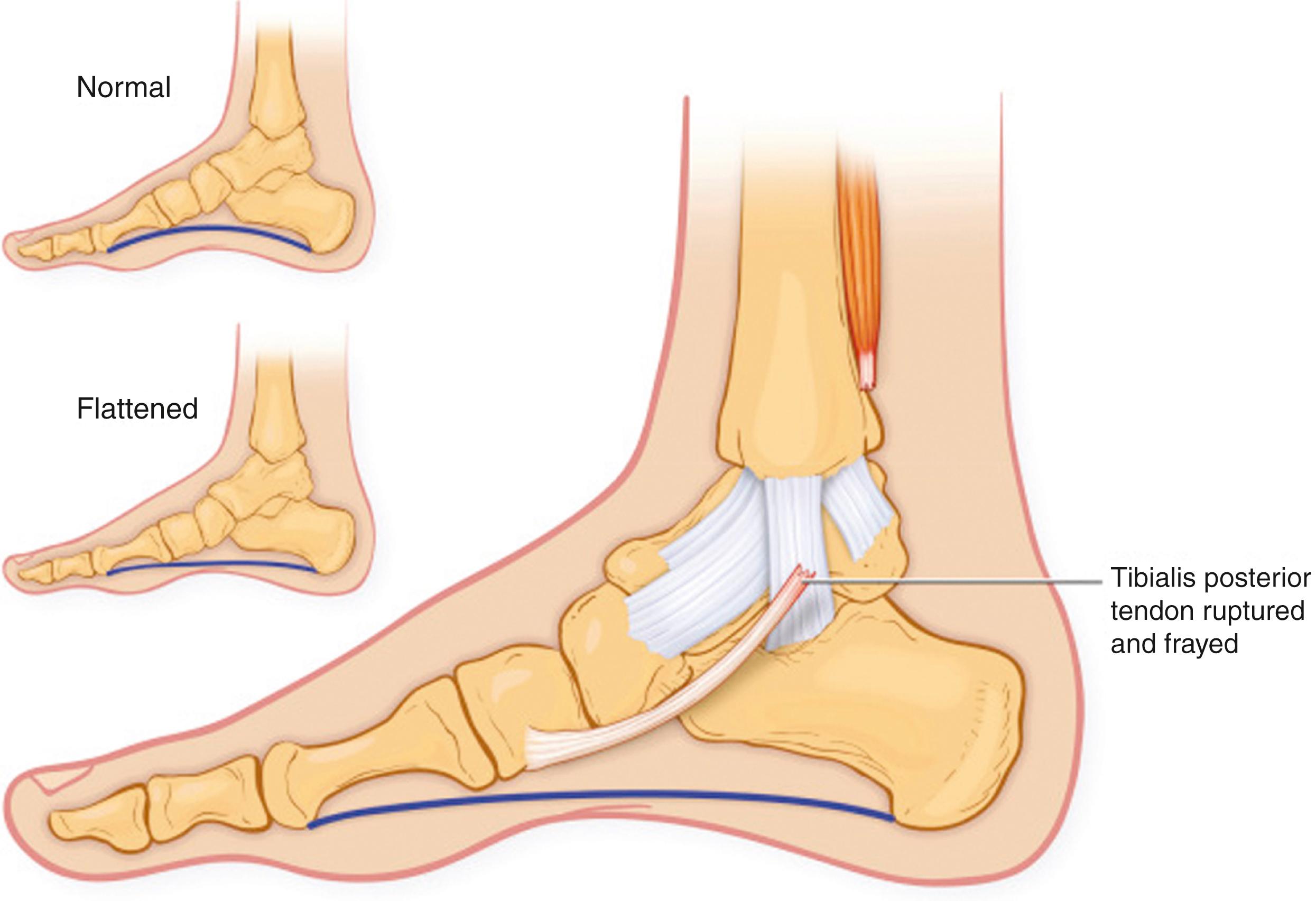 FIG. 192.1, Tendinitis of the posterior tibial tendon. Calcium deposition around the tendon may occur if the inflammation continues, making subsequent treatment more difficult. Continued trauma to the inflamed tendon ultimately may result in tendon rupture.