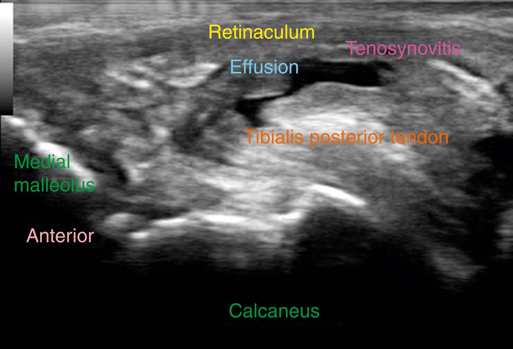 FIG. 192.3, Ultrasound image demonstrating acute tenosynovitis of the tibialis posterior tendon in a patient who was running on sand.