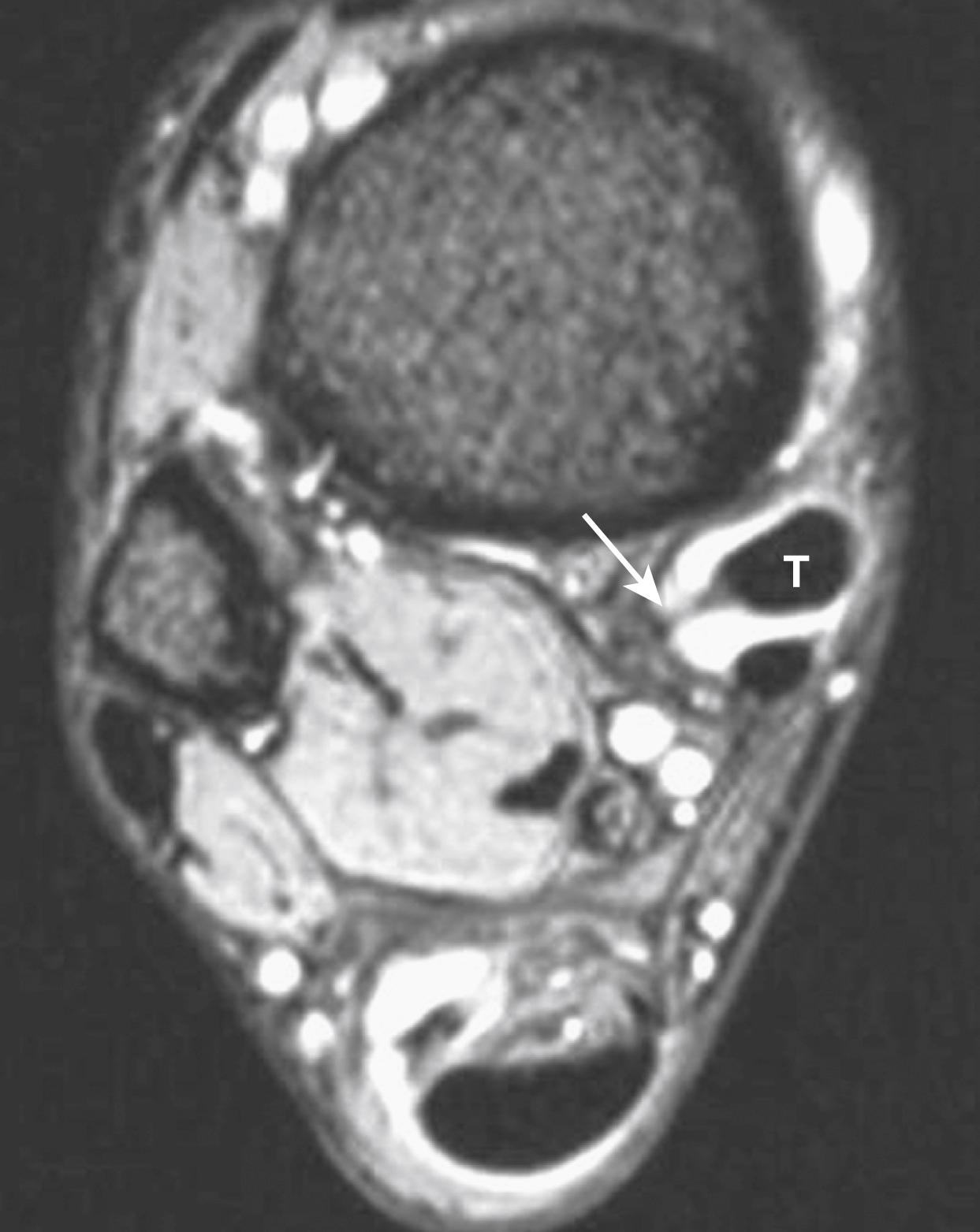 FIG. 192.4, Tenosynovitis. T2∗ axial image of the ankle. The posterior tibial tendon (T) is mildly enlarged but of normal signal intensity. It is surrounded by high signal-intensity fluid, representing tenosynovitis. The thin line within the fluid (arrow) is the mesotendon, in which the tendon invaginated the tendon sheath during fetal development.