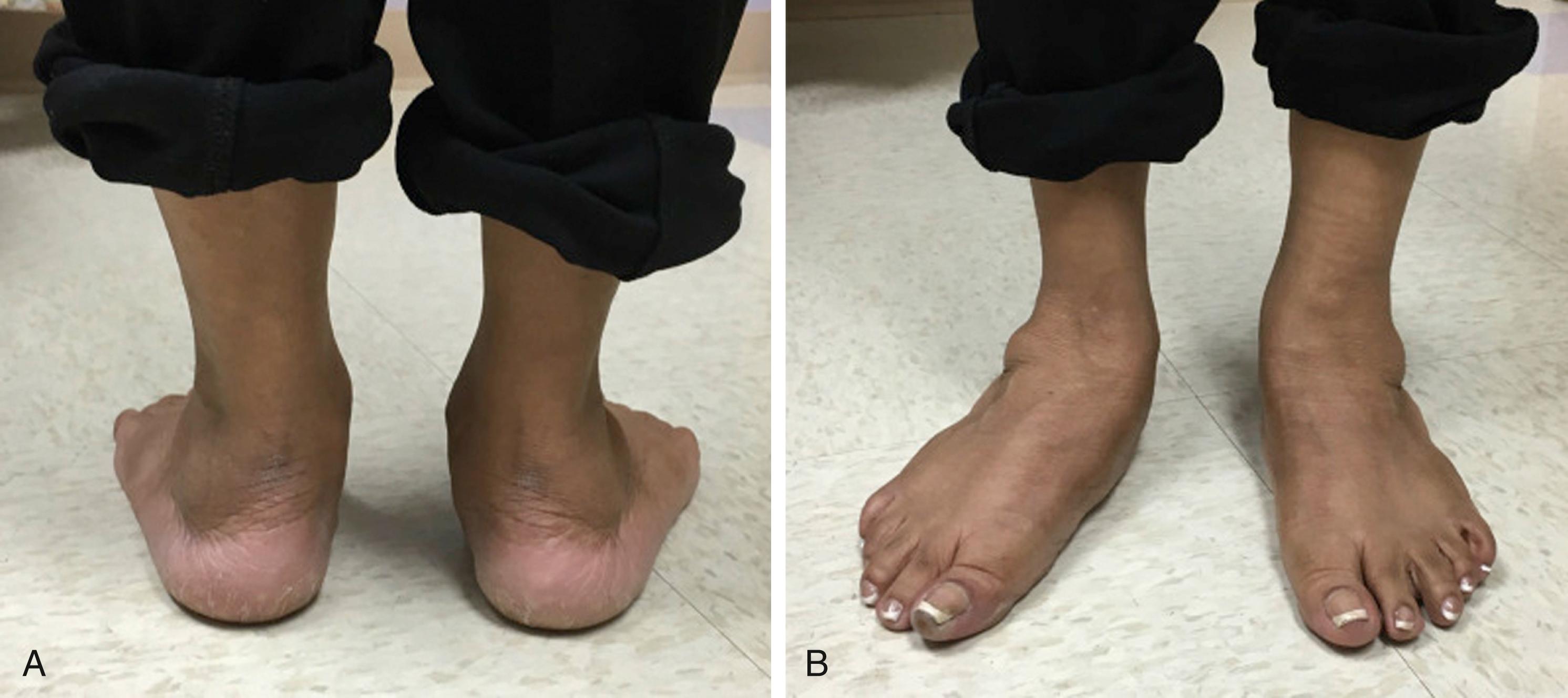 FIG. 192.5, View from (A) posterior and (B) anterior. The positive “too many toes” sign in the posterior tibialis dysfunctional right foot is appreciated when examining the weight-bearing patient from behind. The forefoot is abducted/pronated and the hindfoot is in greater valgus, resulting in more toes seen laterally in the right foot when compared with the left.