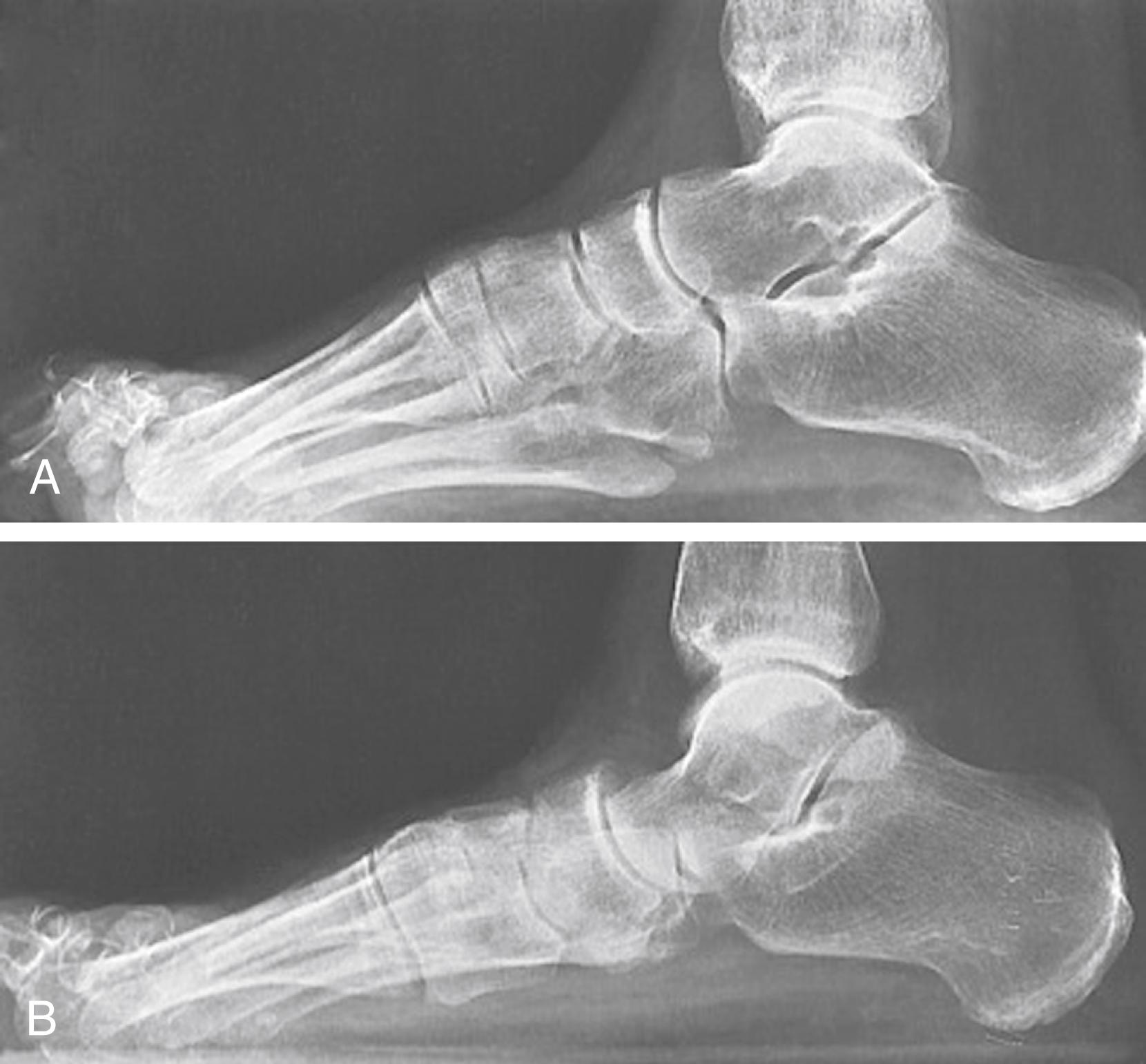 FIG. 192.6, Injuries of the tibialis posterior tendon: complete tears. Although a lateral radiograph obtained without weight bearing (A) appears normal, a lateral radiograph obtained with weight bearing (B) shows plantar flexion of the distal portion of the talus with malalignment at the talonavicular joint.