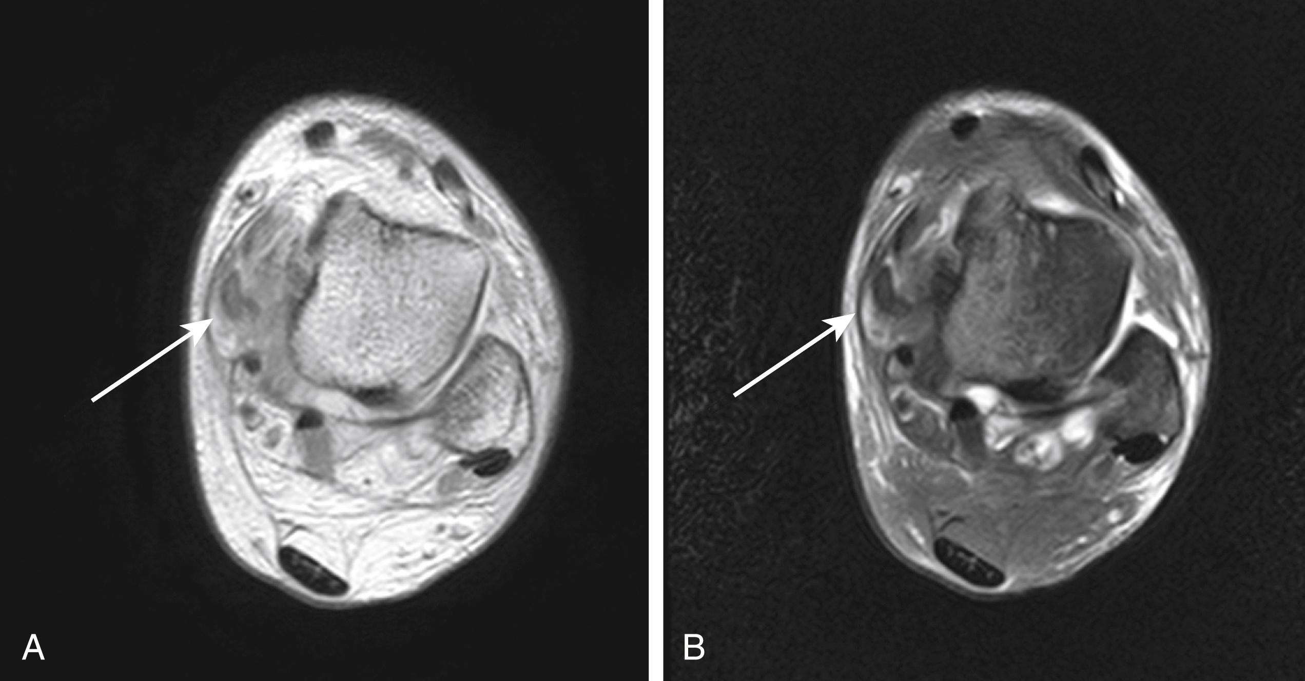 FIG. 192.7, A 54-year-old female with right medial ankle pain after increased activities. All images are using 3-mm slice thickness with 1-mm spacing. (A) T1-weighted magnetic resonance imaging at the same level of the ankle as (B) , which indicates a type 2-3 rupture of the tibialis posterior tendon with surrounding edema (white arrow) . (B) T2-weighted magnetic resonance imaging at the same level of the ankle as A , which indicates a type 2-3 rupture of the tibialis posterior tendon with surrounding edema (white arrow) .