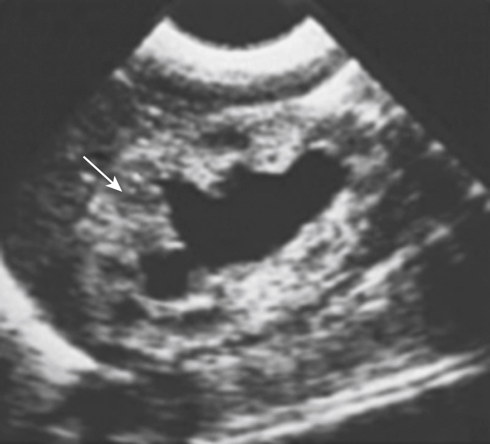 Fig. 57.1, This renal sonogram demonstrates a hydronephrotic kidney with intact corticomedullary junction (arrow) in an infant with posterior urethral valves.