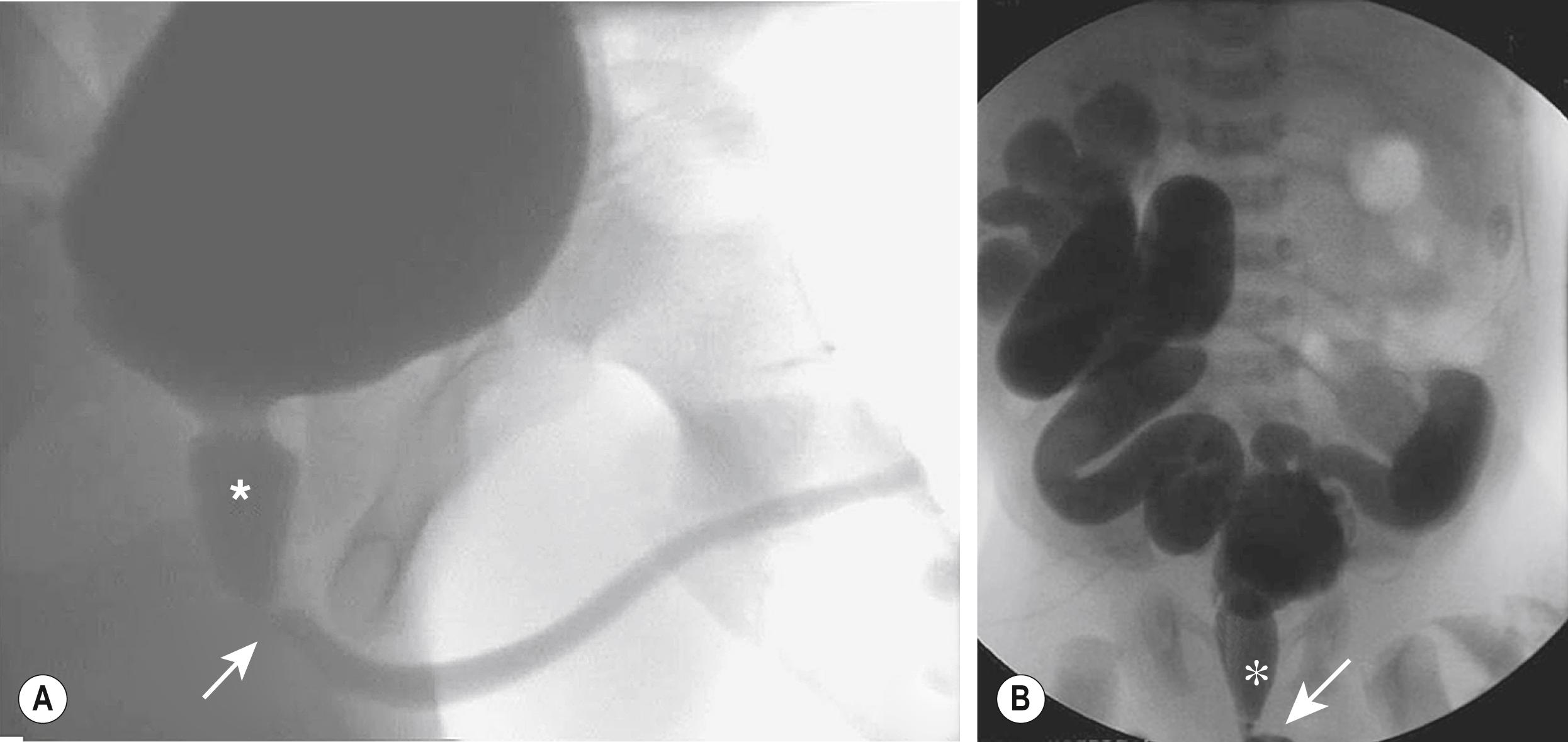 Fig. 57.2, These two voiding cystourethrograms show varying degrees of obstruction from posterior urethral valves. In both studies the location of the valves is marked with an arrow and the posterior urethra is identified with an asterisk. (A) There is no evidence of vesicoureteral reflux. (B) There is massive, bilateral grade V reflux.
