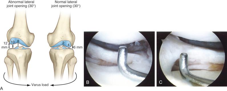FIG 17-2, The gap test. A, The amount of lateral tibiofemoral joint opening is measured with the knee at 25 degrees of flexion. Knees with insufficiency of the posterolateral structures will demonstrate 12 mm of joint opening at the periphery of the lateral tibiofemoral compartment, 10 mm at the midportion of the compartment, and 8 mm at the innermost medial edge. B, Normal gap test. C, Abnormal gap test.