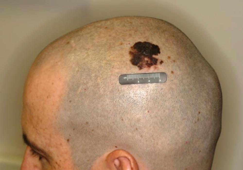 Fig. 71.2, Given the location, this scalp melanoma may require posterolateral neck dissection for gross disease or positive sentinel lymph node biopsy.