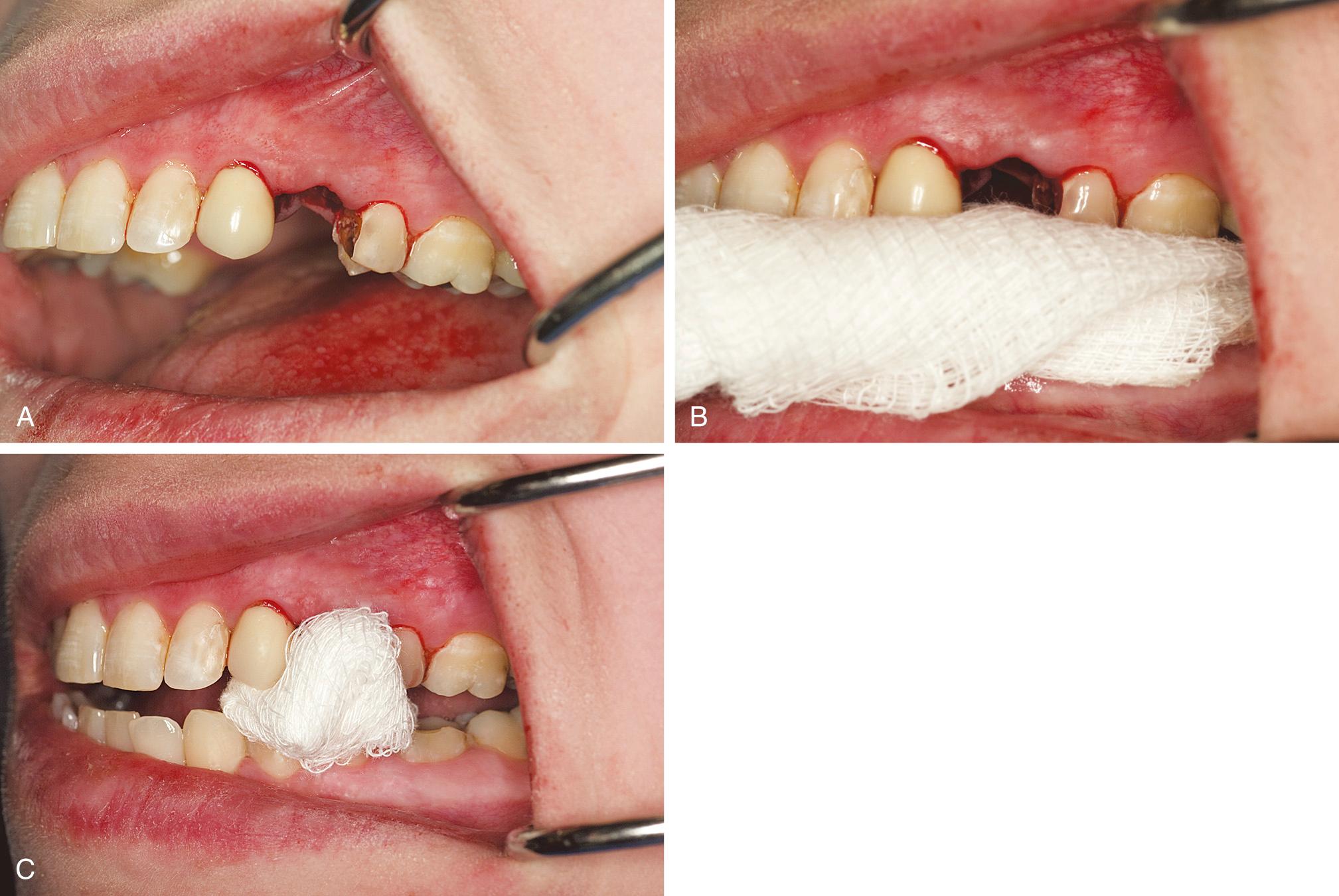 Fig. 11.1, (A) A fresh extraction site will bleed excessively unless a gauze pack is properly positioned. (B) A large or malpositioned gauze pack is not effective in controlling bleeding because the pressure of biting is not precisely directed onto the socket. (C) A small gauze pack is placed to fit only into the area of extraction; this permits pressure to be applied directly on the bleeding socket.