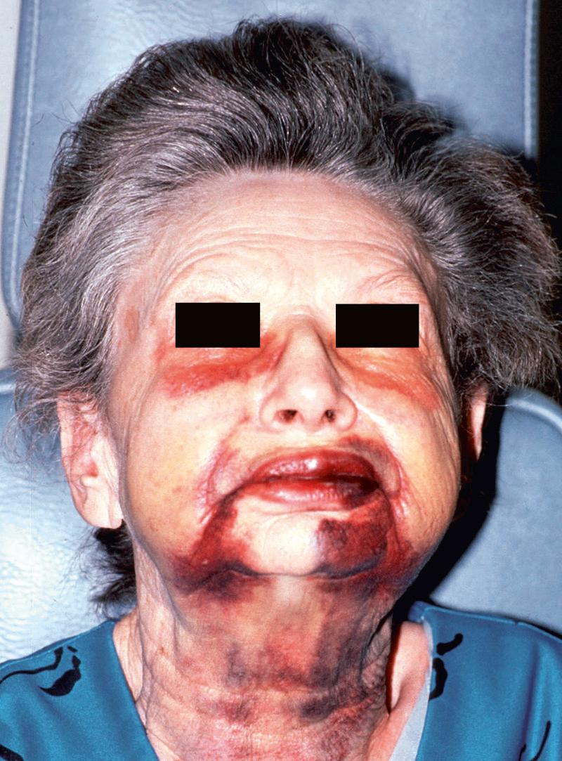 Fig. 11.3, Moderate widespread ecchymosis of right side of face and neck is exhibited in an older patient after extraction of several mandibular teeth.