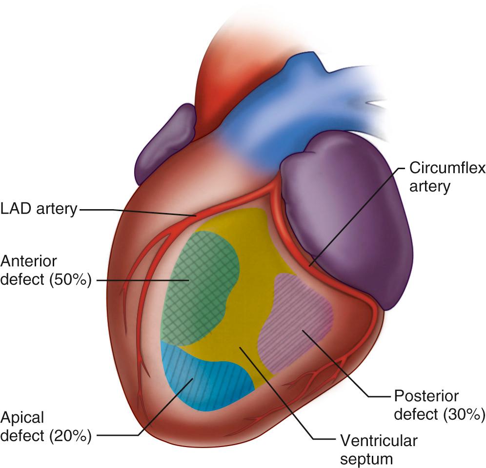 FIGURE 93-1, Distribution of postinfarction ventricular septal defects. LAD, Left anterior descending.