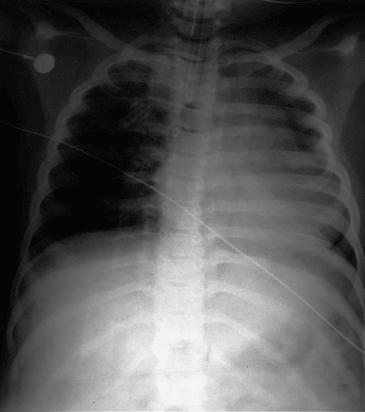 Fig. 201.1, Chest radiograph obtained at the completion of surgery.