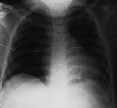 Fig. 201.2, Chest radiograph taken the following morning.