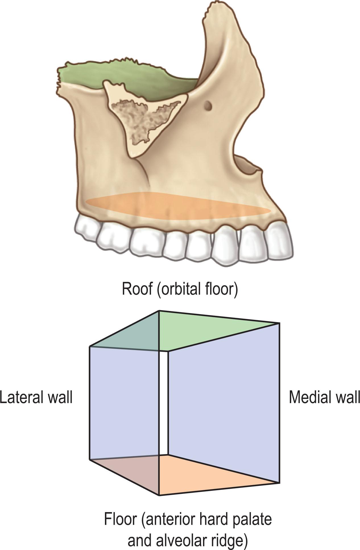 Figure 9.1, The maxilla may be thought of as a six-walled geometric box that includes the roof, which is made up of the orbital floor; the floor of the box, which is made up of each half of the anterior hard palate and alveolar ridge; and the medial wall of the box, which forms the lateral walls of the nasal passage.