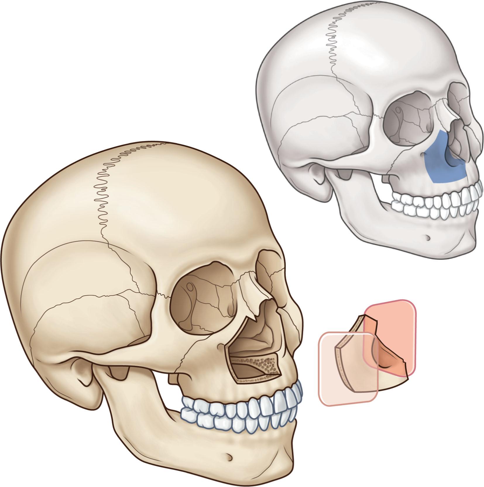 Figure 9.2, Type I, or partial, maxillectomy defects are those that involve one or two walls of the maxilla, most commonly the anterior and medial walls.