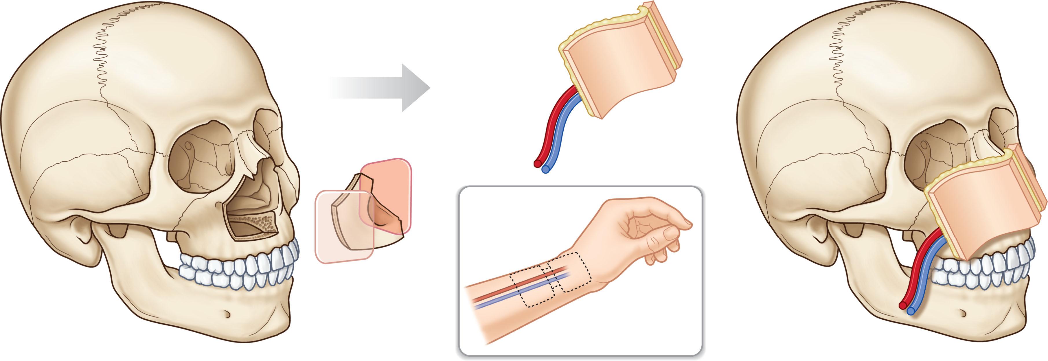 Figure 9.3, For type I defects, the radial forearm free flap provides good external skin coverage and minimal bulk, allowing multiple skin islands to be de-epithelialized to improve contour, wraparound bone grafts, and supply lining for the nasal cavity.