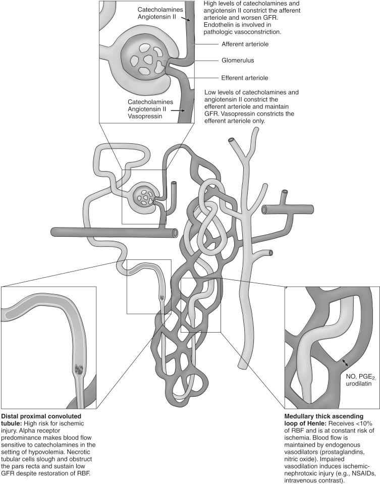 Fig. 165.1, The proximal tubule and medullary thick ascending loop of Henle are potential sites of ischemic and nephrotoxic tubular injury. Both segments have high oxygen consumption and are at risk owing to supply-demand imbalance. GFR, Glomerular filtration rate; NO, nitric oxide; NSAIDs, nonsteroidal antiinflammatory drugs; PGE 2 , prostaglandin E 2 ; RBF, renal blood flow.