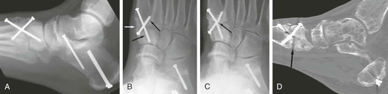 FIGURE 111-1, Failed midfoot arthrodesis. A , Lateral projection immediately after surgery. Two screws transfix an attempted first tarsometatarsal joint arthrodesis. Shown are the internally fixated calcaneal slide and lateral column-lengthening osteotomies. B , Oblique projection 1 month later. A persistent gap is present at the first tarsometatarsal joint space (white arrow), and there is bone resorption around the screws (black arrows), indicating micromotion. C , Three months later, the screws transfixing the fusion site have fatigued and fractured (arrow) because of chronic motion. D , Sagittal CT reformatted image shows nonunion, with a persistent gap between the bones, lack of bridging trabeculae, and formation of neocortex along the bone ends (arrow). Disuse osteoporosis is present in the hindfoot.