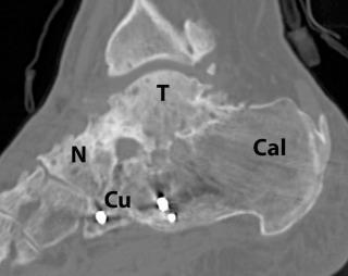 FIGURE 111-2, Solid hindfoot triple arthrodesis. Sagittal CT reconstruction with bone window demonstrates bridging trabecular bone spanning the subtalar, calcaneocuboid, and talonavicular joints. Cal, Calcaneus; Cu, cuboid; N, navicular; T, talus.