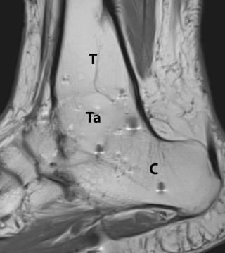 eFIGURE 111-1, Solid ankle and subtalar arthrodesis. A sagittal T1-weighted MR image shows continuity of the marrow between the tibia (T), talus (Ta), and calcaneus (C).