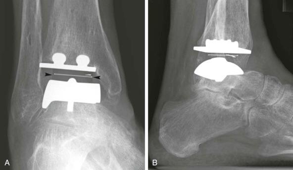 FIGURE 111-3, Normal total ankle replacement (TAR). Anteroposterior ( A ) and lateral ( B ) radiographs of the ankle demonstrate a TAR with mobile polyethylene bearing (arrowheads) articulating between metallic tibial and talar components, which are secured in bone using keels rather than cement. Component alignment is near-anatomic, and the distal fibula remains intact.