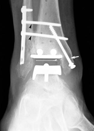 FIGURE 111-4, Total ankle replacement (TAR) with distal tibiofibular joint arthrodesis for management of posttraumatic ankle osteoarthritis, resulting from bimalleolar ankle fractures and syndesmotic injury. Anteroposterior ankle radiograph demonstrates TAR with mobile polyethylene bearing between talar and tibial metallic components. Syndesmotic arthrodesis is fixated with two cortical screws (arrowheads) through a preexisting fibular plate. Medial malleolar lag screws fixate a healed medial malleolar fracture.
