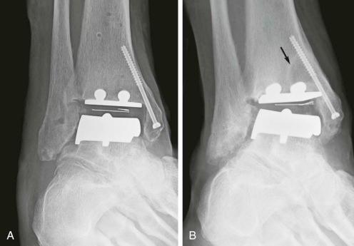 FIGURE 111-5, Failed total ankle replacement (TAR) due to edge loading. A , Initial anteroposterior ankle radiograph demonstrates normal TAR with intact liner, near-anatomic component position, and partially threaded screw transfixing a medial malleolar osteotomy. B , Follow-up anteroposterior ankle radiograph depicts new valgus tilt of the talar component due to asymmetric liner wear. There are several new circumscribed erosions in the subchondral bone of the distal tibia and fibula, the largest in the medial tibia (arrow), due to osteolysis. The patient was managed with liner exchange and corrective osteotomies.