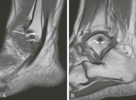 FIGURE 111-6, Lateral ankle ligament repair. A , A sagittal T1-weighted MR image demonstrates ferromagnetic artifact (long arrow) in the distal fibula from suture anchors. Shown is the normal course of the peroneus brevis tendon (short arrows). B , A sagittal image located more medially shows artifact from anchors at the distal attachment of the repaired anterior talofibular and ligament (arrow).