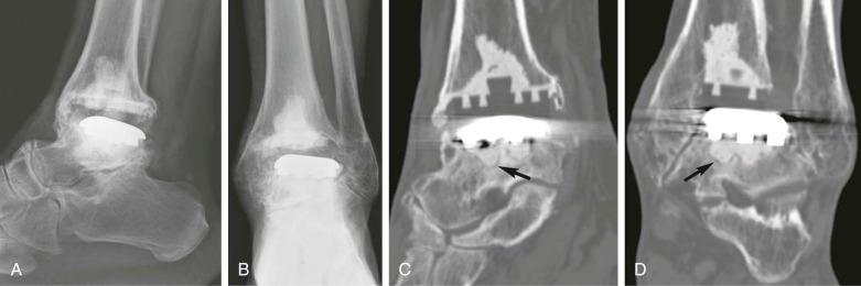 eFIGURE 111-2, Loosened total ankle replacement. Lateral ( A ) and anteroposterior ( B ) ankle radiographs demonstrate posterior talar subluxation and varus tilt. Sagittal ( C ) and coronal ( D ) bone window CT images show resorption at the bone-cement interface of the talar component (arrows) due to loosening.