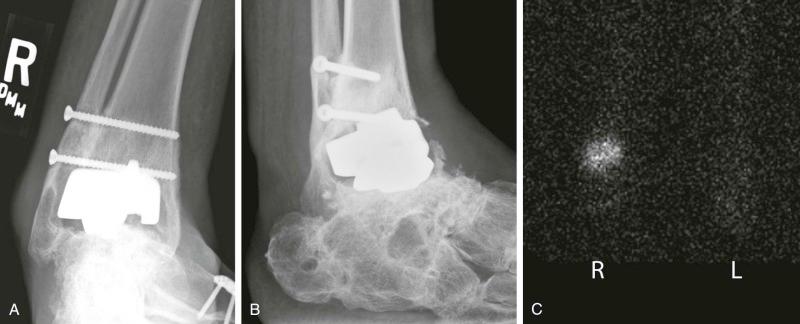 eFIGURE 111-3, Infected total ankle replacement (TAR). Anteroposterior ( A ) and lateral ( B ) ankle radiographs demonstrate extensive bone resorption around the tibial and talar components of a TAR. There is solid hindfoot triple arthrodesis and instrumented fusion of the tibiofibular syndesmosis. C , Anterior projection of both ankles from indium-111 labeled white blood cell (WBC) scan demonstrates markedly increased WBC activity in the right ankle (R), compared with normal background activity on the left (L). This was managed with débridement and antibiotic spacer placement, and cultures yielded coagulase-negative Staphylococci .