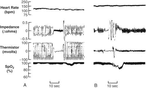 Fig. 202.1, Postoperative recording of heart rate, chest wall movement (impedance), nasal airflow (thermistor), and oxygen saturation (Sp o 2 ) from an infant after general inhalation anesthesia for inguinal hernia repair.