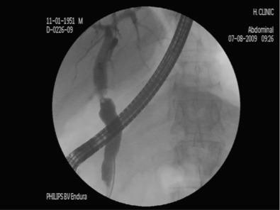 FIG 54.3, Biliary anastomotic stricture after liver transplantation. The structure is quite short and in the area of the anastomosis. These strictures are amenable to endoscopic therapy with biliary dilation and subsequent plastic stent placement across the stricture.