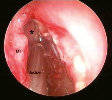 Fig. 12.1, View through a 30-degree endoscope with a malleable, curved suction tube. With this device, the left natural frontal recess can easily be identified by following a stent placed intraoperatively (asterisk). MT, Middle turbinate.