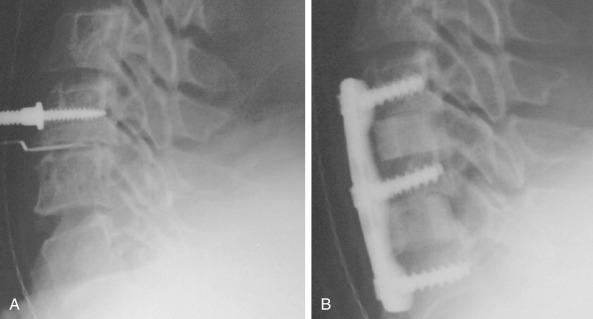 FIG. 105.1, (A) This intraoperative radiograph shows that the Caspar distraction pin has been placed into the body of C5 parallel to the caudal endplate. Note the hyperlordosis at C6–C7 with the touching spinous processes. A Caspar pin is then placed into C7 parallel to its rostral endplate. The tips of the pins converge. When the Caspar distractor is placed over the pins, it brings them into parallel alignment and reduces the lordosis. (B) Postoperative lateral radiograph shows correction of the hyperlordosis after graft placement and plating.