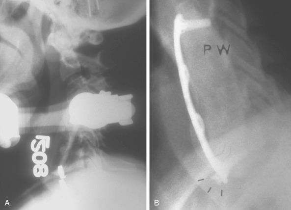 FIG. 105.11, (A) This patient had a two-level corpectomy. Graft extrusion occurred despite postoperative immobilization in a two-poster brace. (B) This lateral radiograph illustrates what can happen after a long corpectomy. The plate does not prevent subsidence and collapse of the graft and screw into the next disc space occurs.